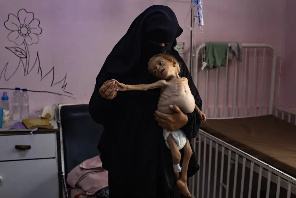 Palestinian child Sham Qudeih amid the famine spreading across Gaza. EPA/HAITHAM IMAD